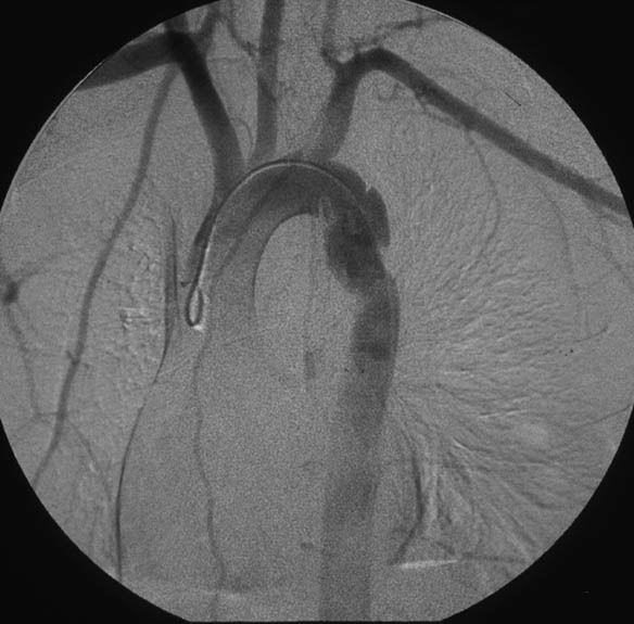 Thoracic Aortic Thoracic Aortic Crossclamping