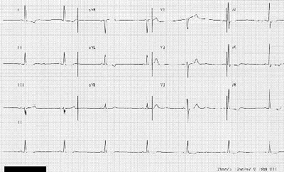 Ekg Rate