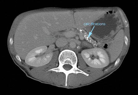 CT Image of the Pancreas in a