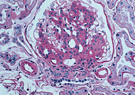 of nephrotic edema, proteinuria and hypertension, became synonymous with Kimmelstiel-Wilson Disease. Figure 1. Diffuse and Nodular Diabetic Sclerosis.