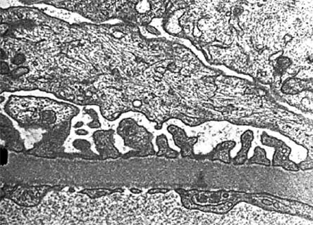 gbm cyberounds microscopy em electron membrane glomerular basement figure