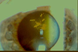 Snowflake Cataract